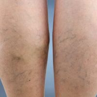 Palatine Varicose Vein Treatment Clinic ico
