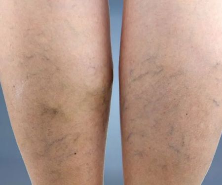 Palatine Varicose Vein Treatment Clinic