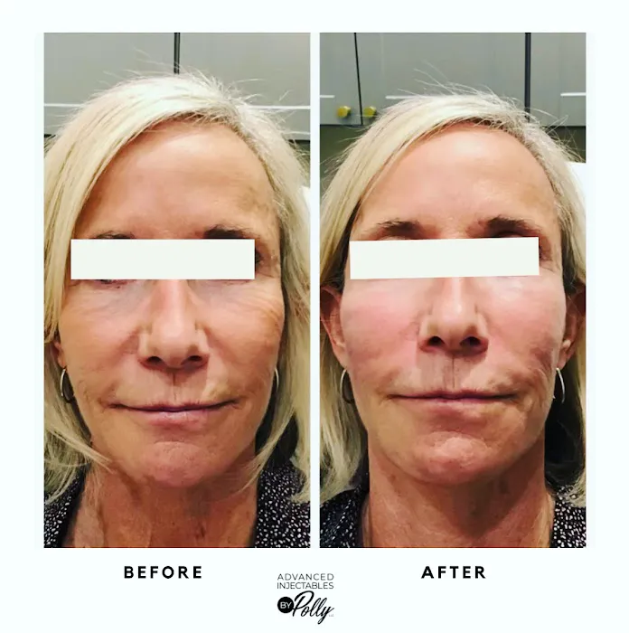 Advanced Injectables By Polly Picture 6