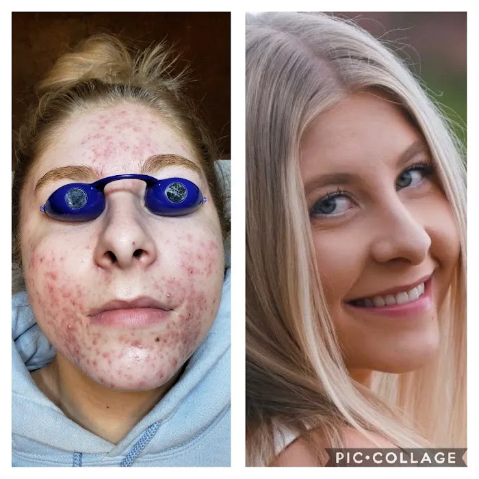 Denver Healthy Skin & Acne Clinic Picture 9