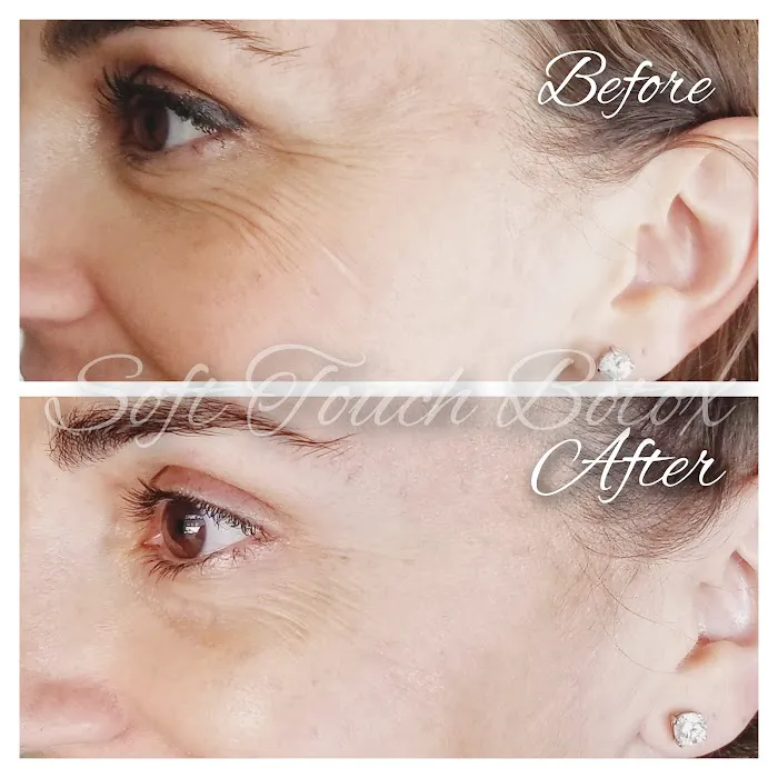 Soft Touch Botox Picture 4