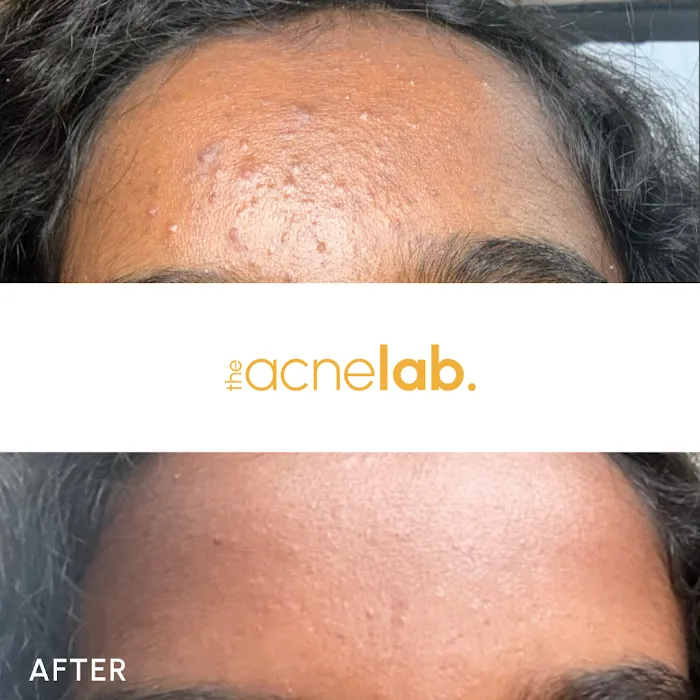 The Acne Lab Picture 9