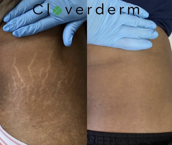 Cloverderm Picture 6