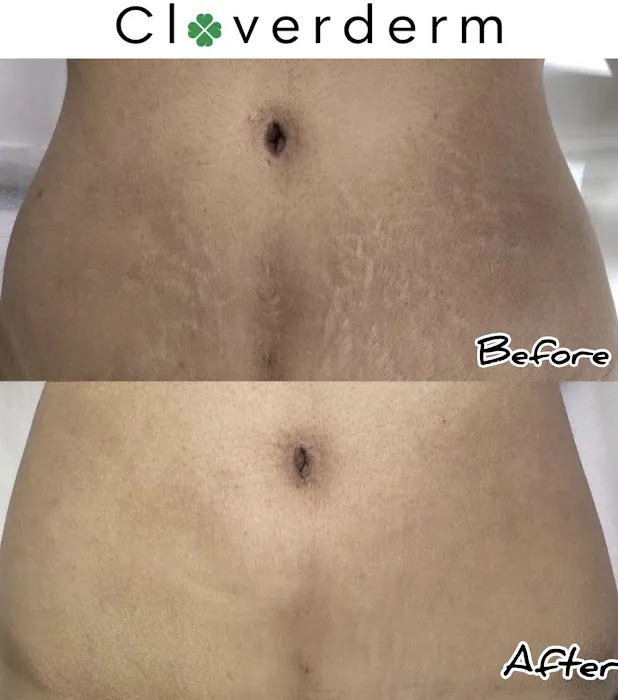 Cloverderm Picture 8