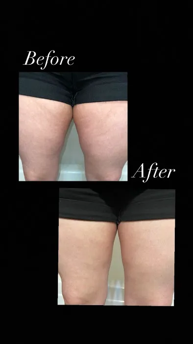 Fibroblast Skin Rejuvenation Picture 3