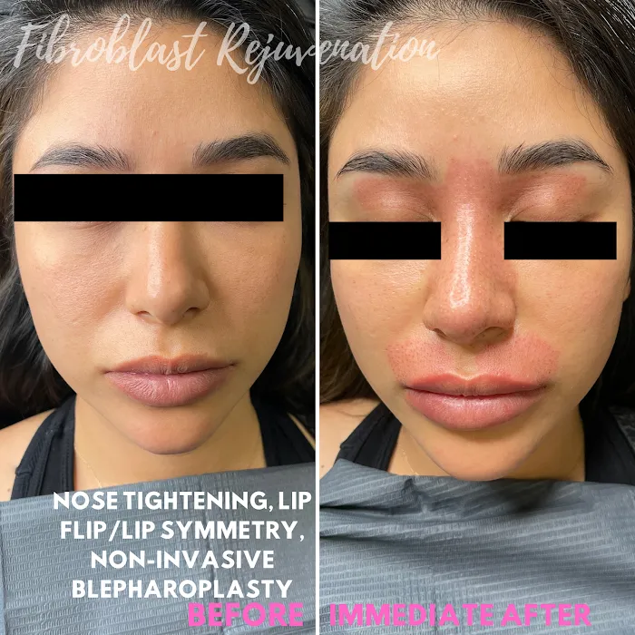 Fibroblast Skin Rejuvenation Picture 5