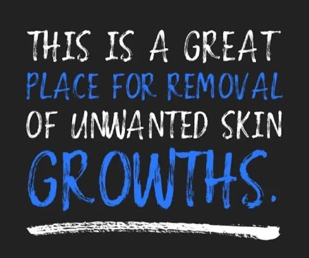 Sonic Skin Care Houston Laser Skin Growth And Mole Removal