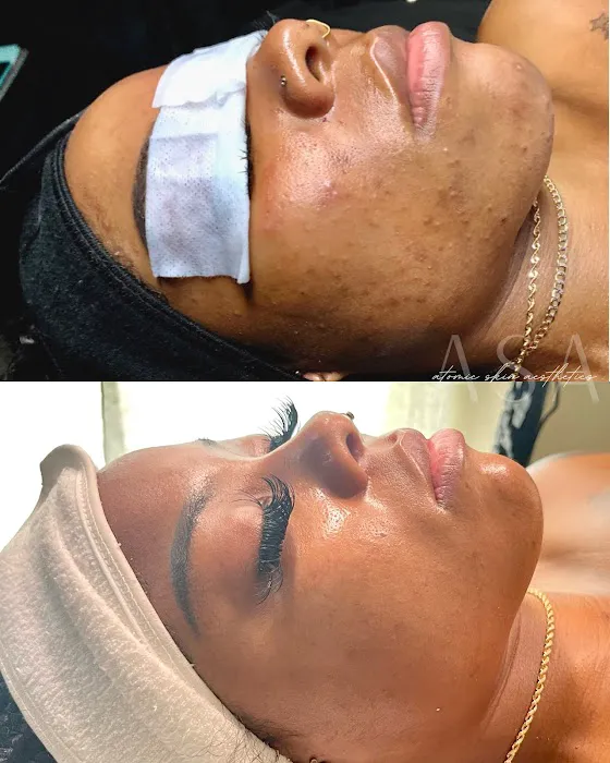 Atomic Skin Picture 1