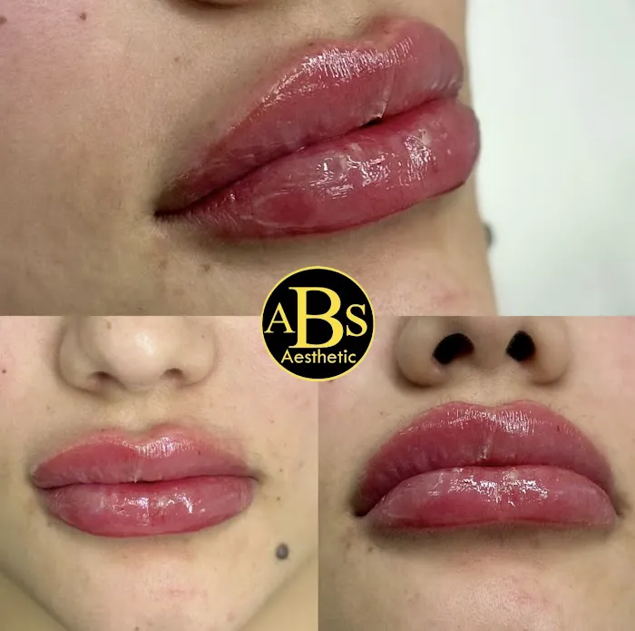 ABS medical aesthetic Picture 5