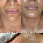 Jerry Shipman Skin Revision