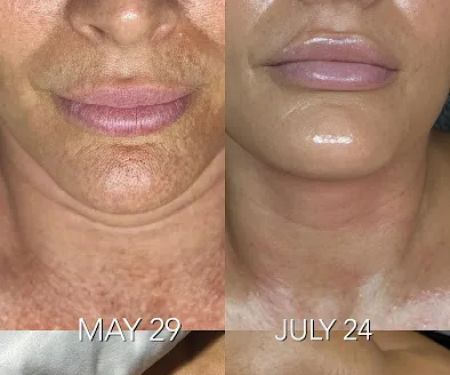 Jerry Shipman Skin Revision