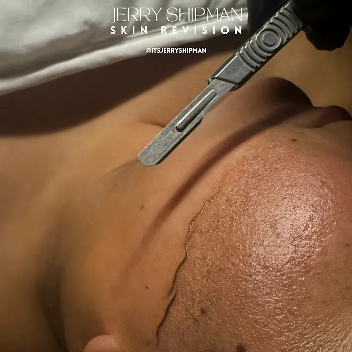 Jerry Shipman Skin Revision Picture 4