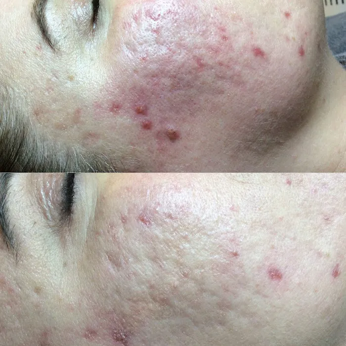 San Diego Acne Clinic Picture 9