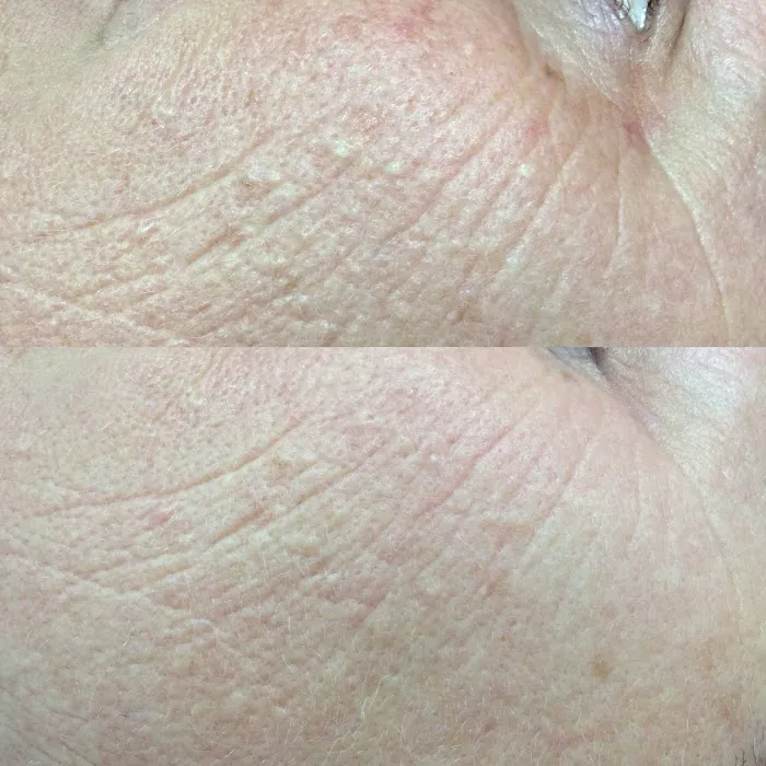 San Diego Acne Clinic Picture 7