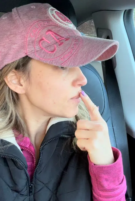 Mole Removal San Diego Picture 2