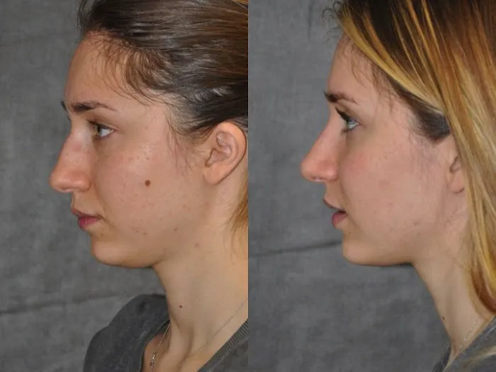 Mole Removal San Diego Picture 4