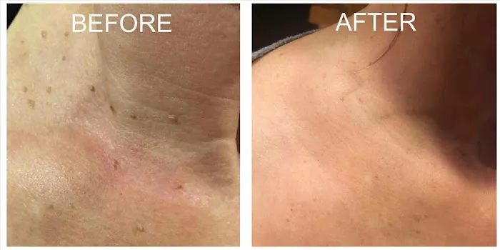 Mole Removal San Diego Picture 5