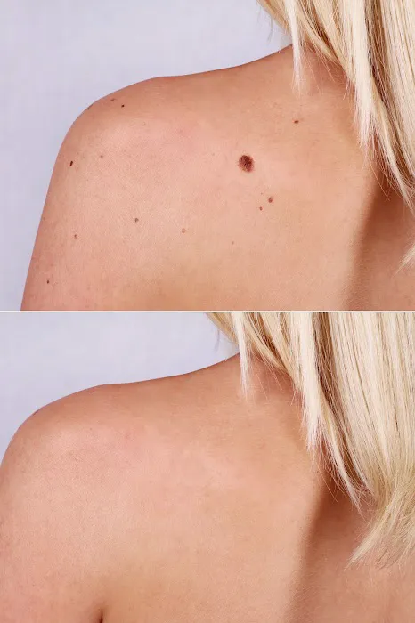 Mole Removal San Diego Picture 1