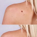 Mole Removal San Diego
