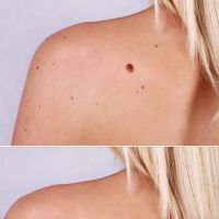 Mole Removal San Diego ico