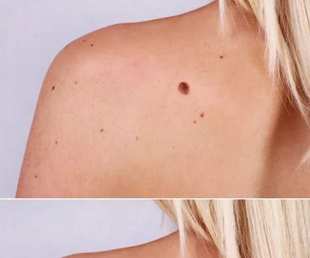 Mole Removal San Diego
