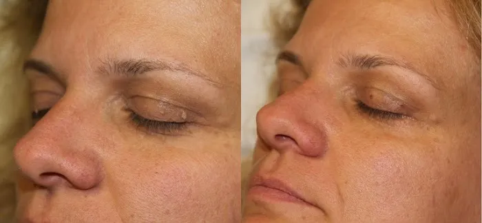 Mole Removal San Diego Picture 3