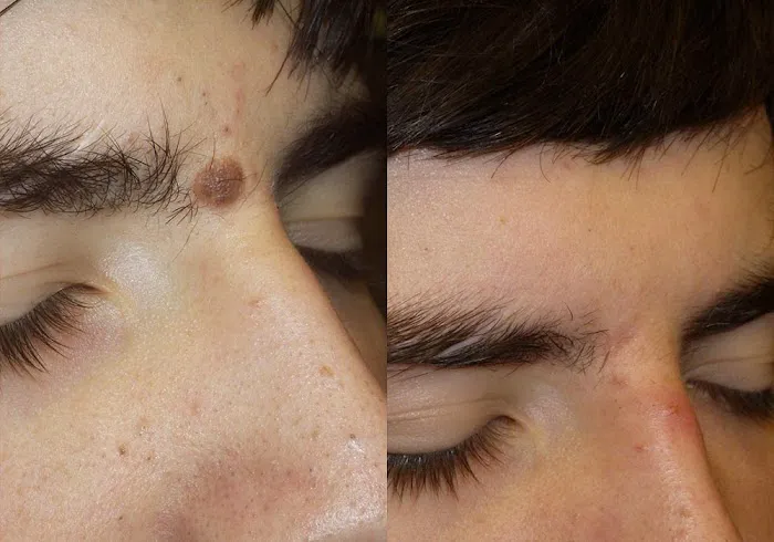 Mole Removal San Diego Picture 10