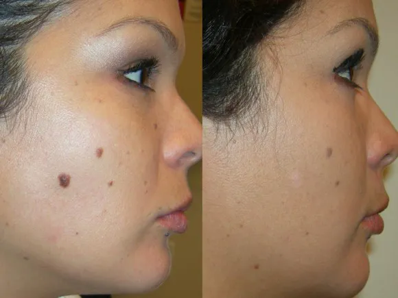 Mole Removal San Diego Picture 8