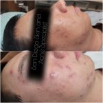 San Diego Skin and Acne Specialist
