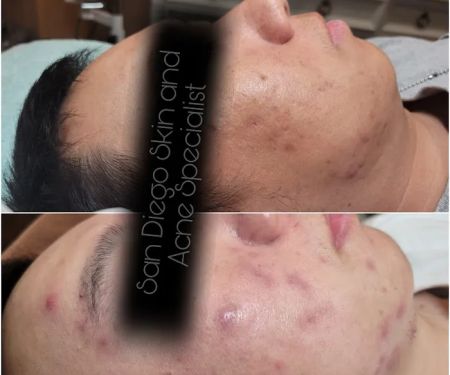 San Diego Skin and Acne Specialist