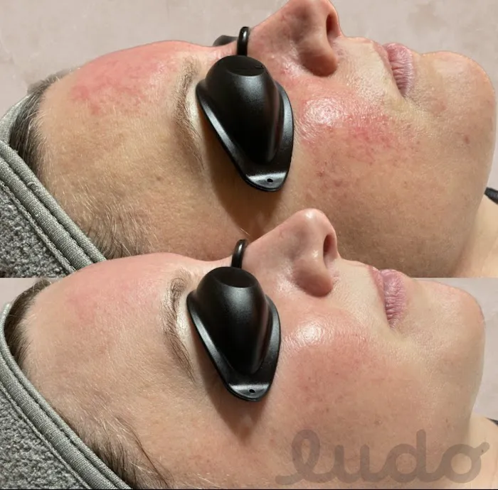 Ludo Acne & Aesthetics Picture 3