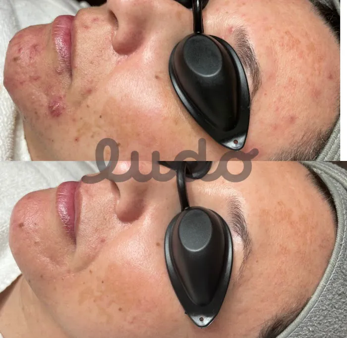 Ludo Acne & Aesthetics Picture 10