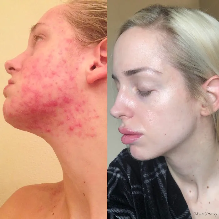 Skin Klarity Picture 9