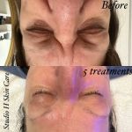 Studio H Skin Care - Hydrafacial