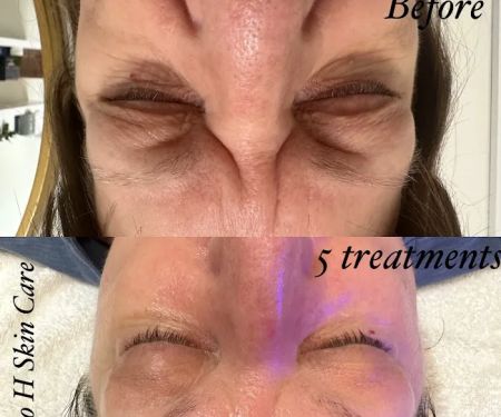 Studio H Skin Care - Hydrafacial