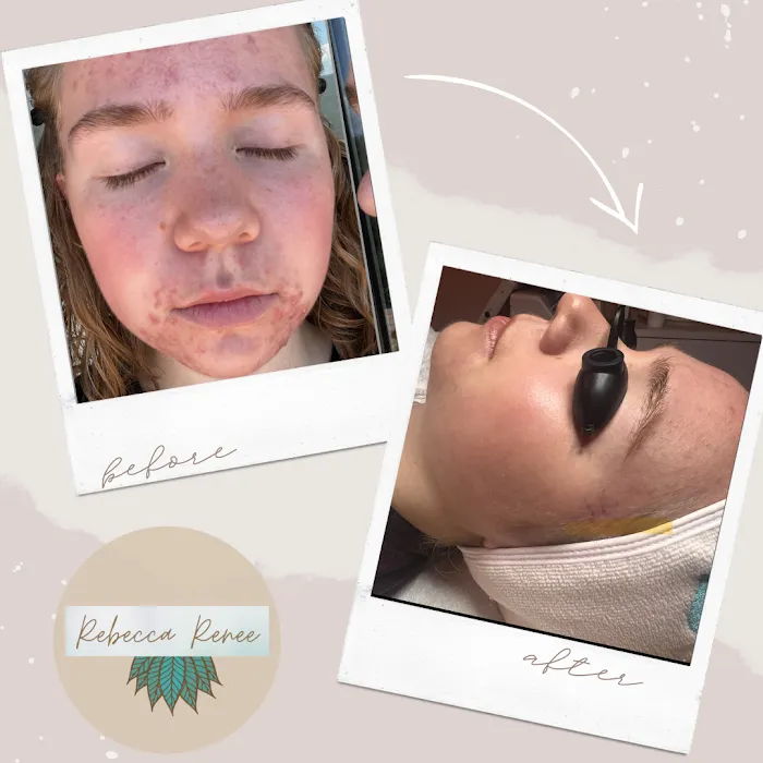Rebecca Renee Skincare Holistic Acne Clinic Picture 2