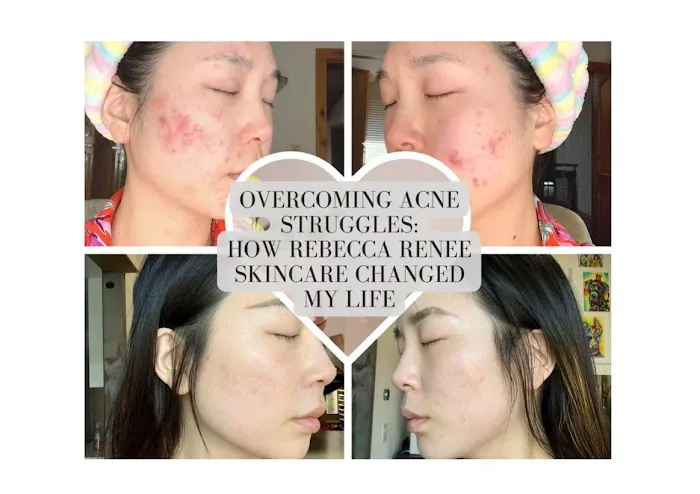 Rebecca Renee Skincare Holistic Acne Clinic Picture 1