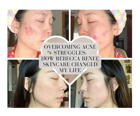 Rebecca Renee Skincare Holistic Acne Clinic