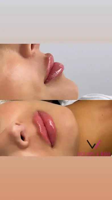 Lily Lips & Nose Picture 4