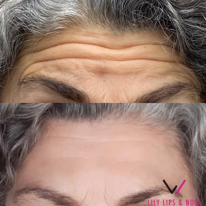 Lily Lips & Nose Picture 7