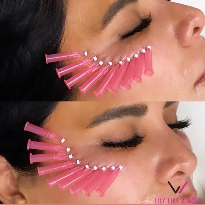 Lily Lips & Nose Picture 2