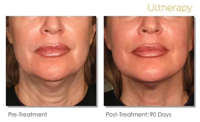 Miami Skin Tightening and Fat Reduction Picture 2