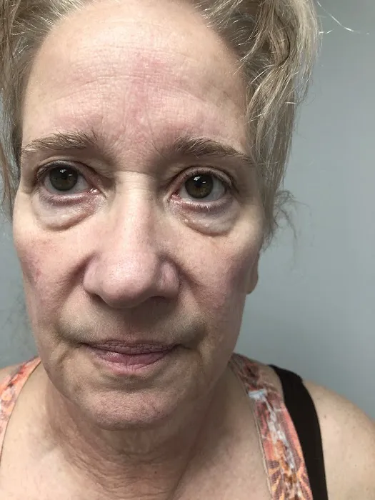 Miami Skin Tightening and Fat Reduction Picture 5