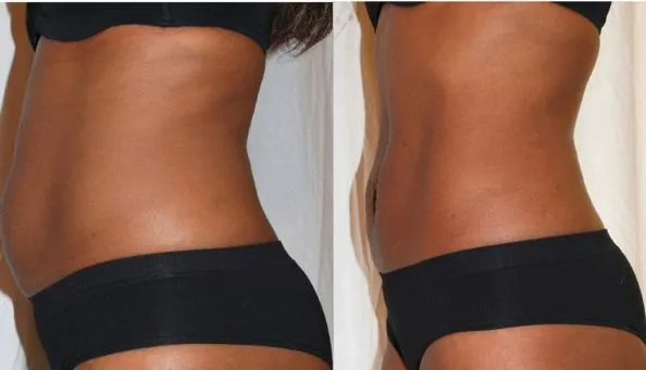 Miami Skin Tightening and Fat Reduction Picture 1