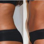 Miami Skin Tightening and Fat Reduction