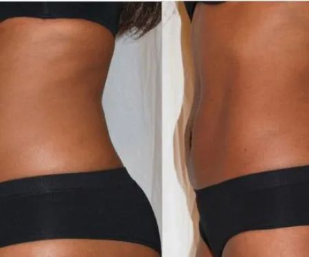 Miami Skin Tightening and Fat Reduction