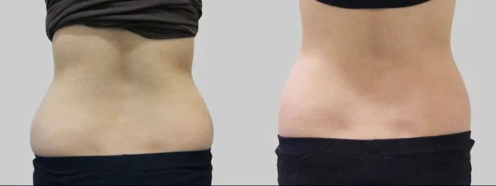 Miami Skin Tightening and Fat Reduction Picture 4