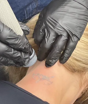 Erase Ink Laser Tattoo Removal Picture 3
