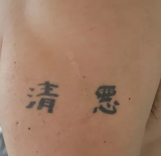 Erase Ink Laser Tattoo Removal Picture 1