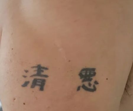 Erase Ink Laser Tattoo Removal